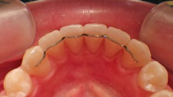 Retainer-Draht (fest)